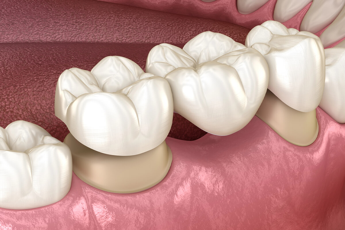 dental veneers in pragathi nagar